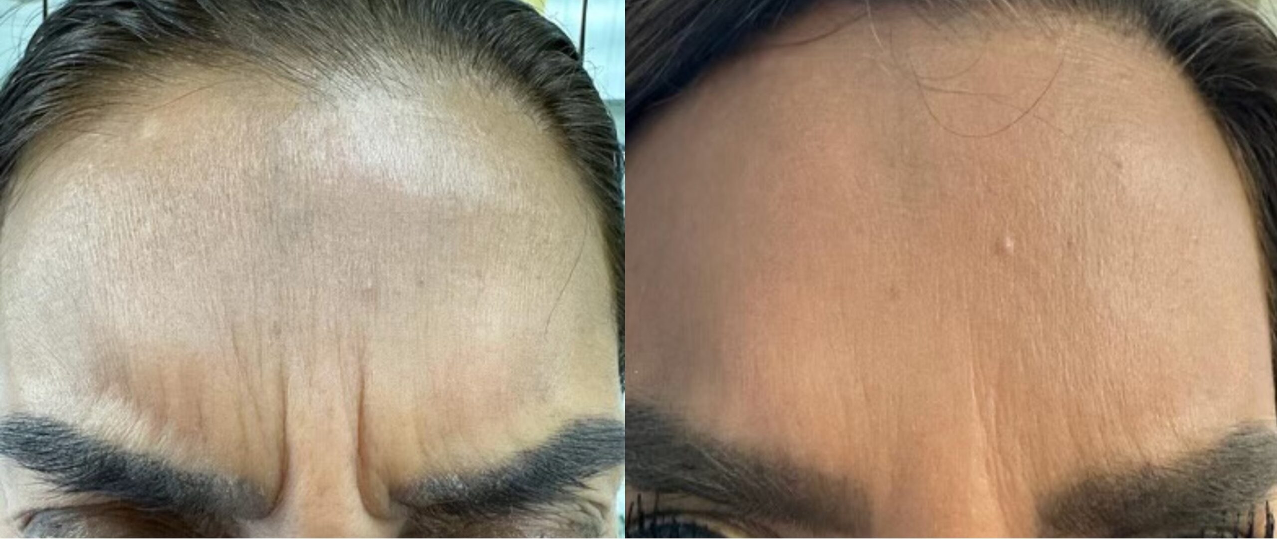 testimonio botox 2