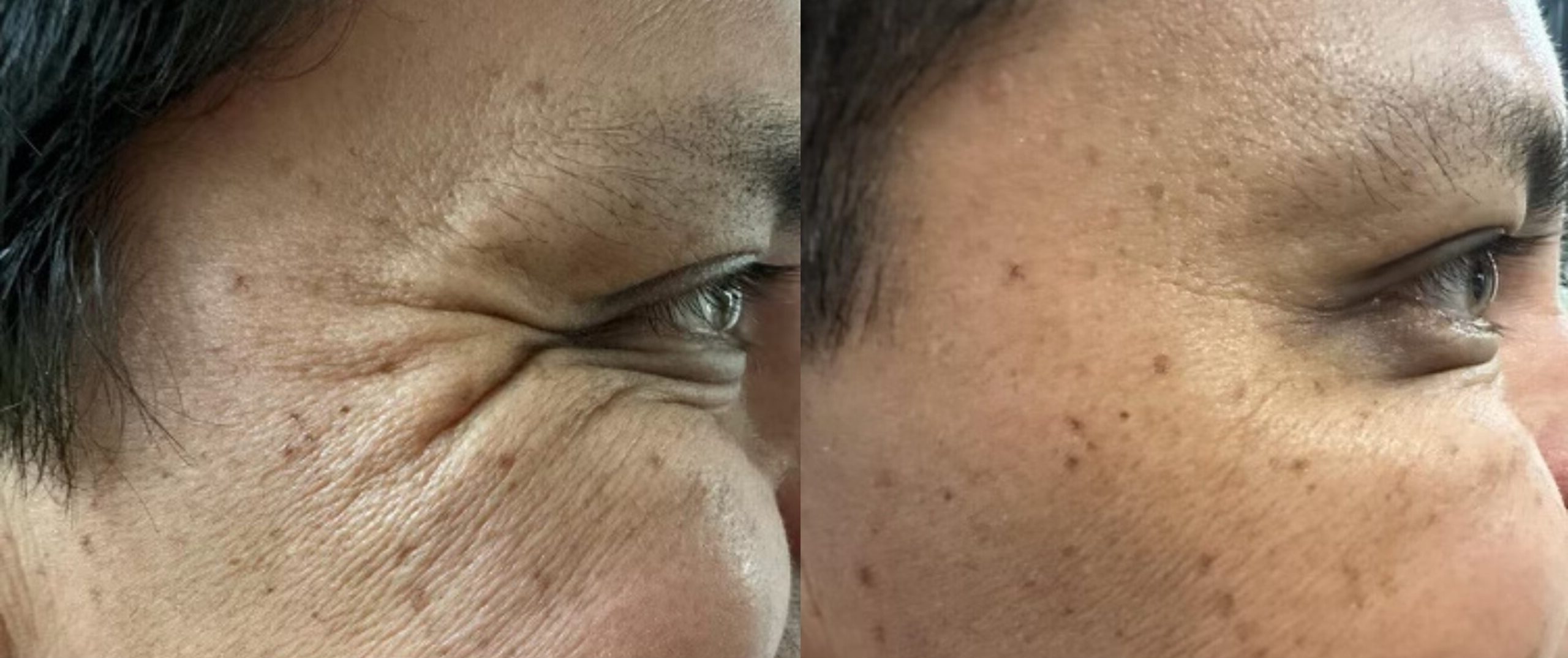 testimonio botox1