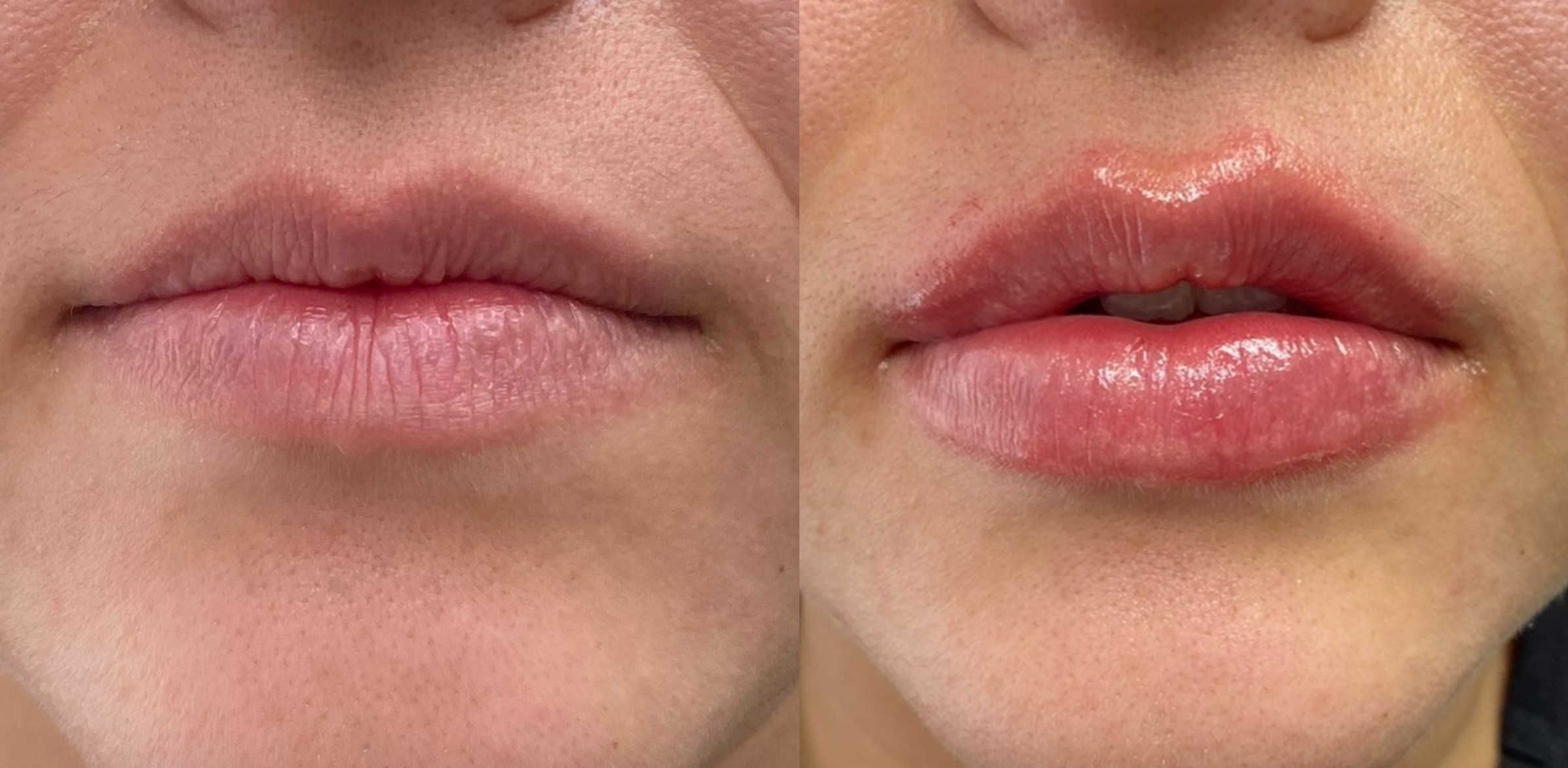 testimonio fillers